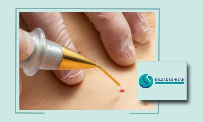 درمان زگیل تناسلی با لیزر در یزد با بهترین دستگاه