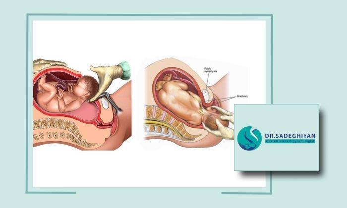 سزارین یا زایمان طبیعی؟ تفاوت‌ها و انتخاب درست برای شما