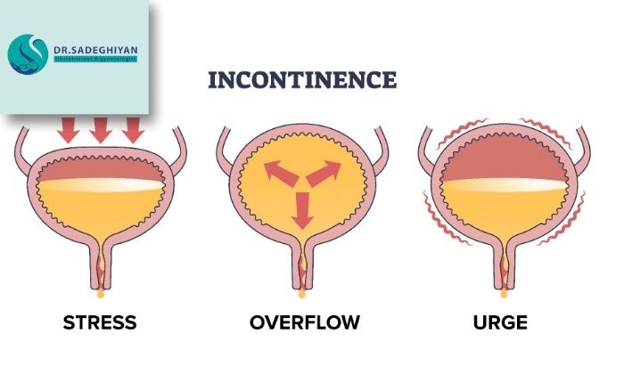 علل شایع بی‌اختیاری ادرار در زنان