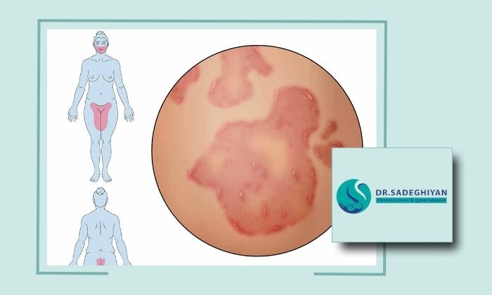 چطور بفهمیم دچار عفونت مقاربتی شده‌ایم و راه درمان چیست؟